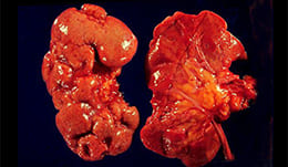Infecție de rinichi